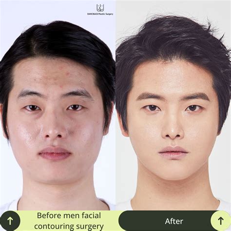 Face Contouring Surgery