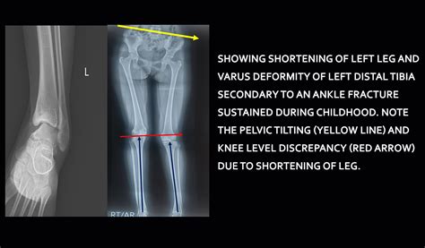 Limb Lengthening in Delhi | Dr. Yashwant Singh Tanwar