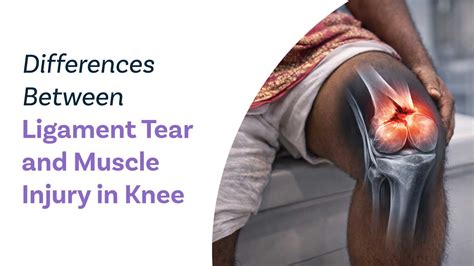 Differences Between Ligament Tear and Muscle Injury in Knee