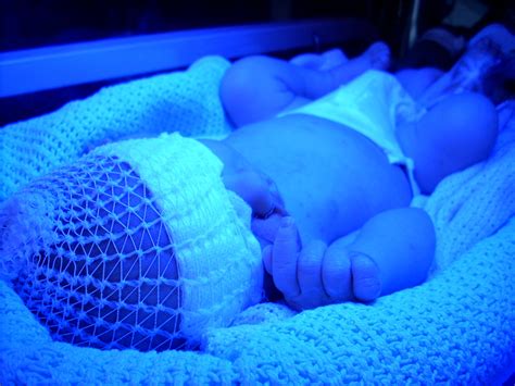 Babies and Jaundice - Toronto Family Doulas