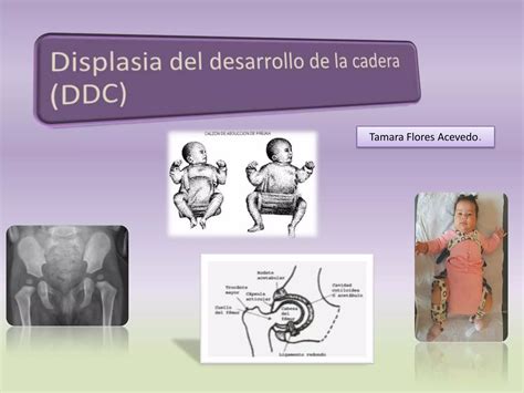 Displasia del desarrollo de las caderas | PPTX