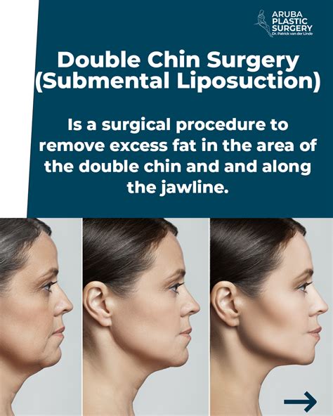 All About Double Chin Surgery – Aruba Plastic Surgery