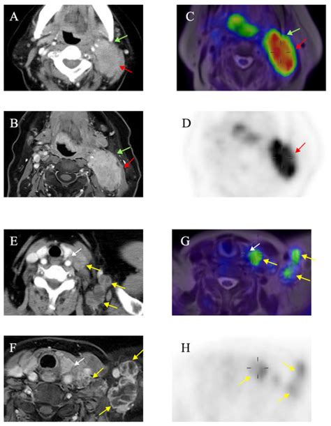 Application of 18F-FDG Positron Emission Tomography/Magnetic Resonance ...