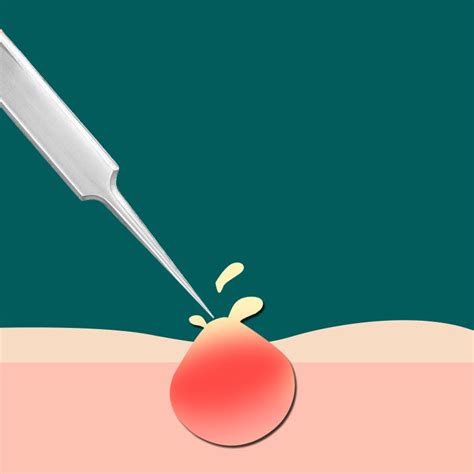Acne Blackhead Removal Kit Extractio Kit for Zit Removing Whitehead Po ...