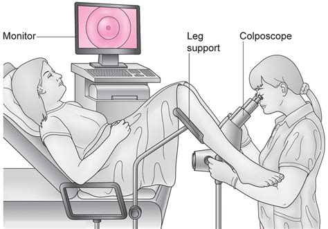 Colposcopy - Colposcopy Biopsy, Results, HPV, Side Effects