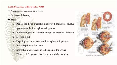 Lateral Internal Sphincterotomy
