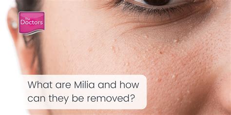 Milia Removal Norwich - Expert Laser Treatment