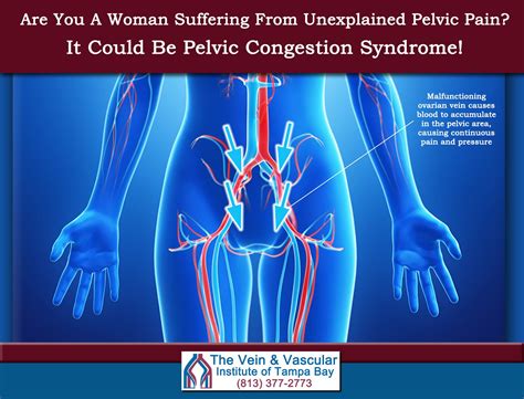 What is pelvic congestion syndrome – Artofit