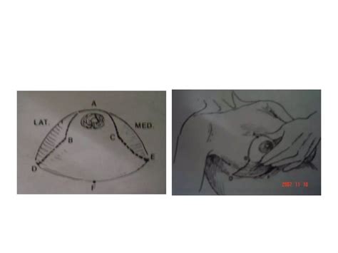 Reduction mammoplasty | PPTX