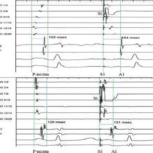 Image result for Counterclockwise Atrial Flutter