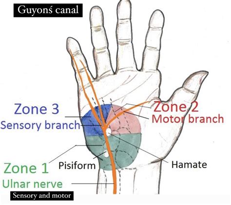 Ulnar (Guyonś) Canal