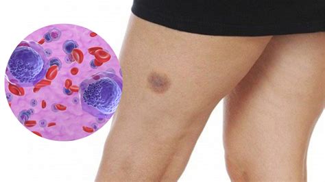 Leucemia: Qué es, cuáles son sus síntomas y cómo se trata