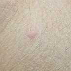 plane wart icd 10 | Grab Your ₹600 App Bonus Instantly | nibandhan ...