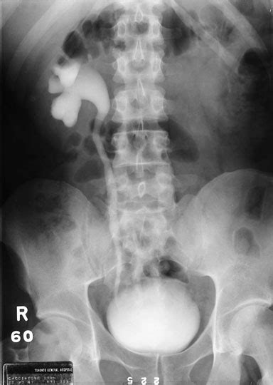 Image result for Normal Intravenous Pyelogram