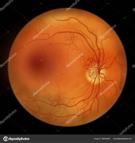 Proliferative Diabetic Retinopathy Illustration Showing ...