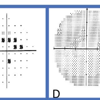 Image result for Visual Field Graph