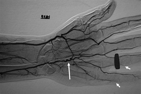 AJR Teaching File: Carpenter With Cold, Numb Fingers | AJR