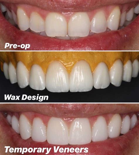 How Long Does Veneers Process Take at Jack Oconnell blog