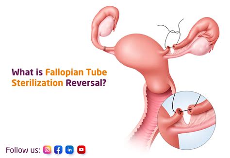 Image result for Removing Fallopian Tubes