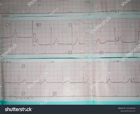 Image result for ECG Examples