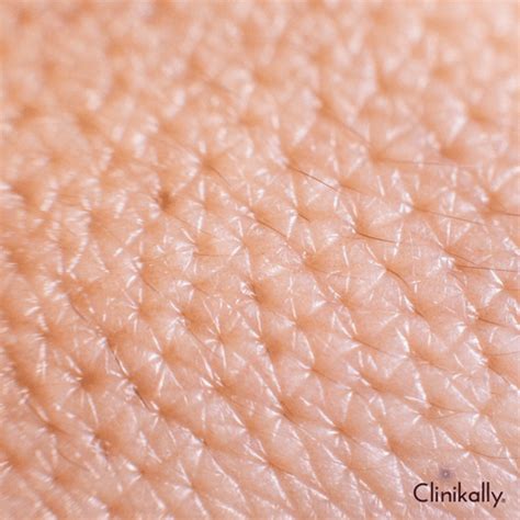 What is Strawberry Skin and How to Treat It? | Clinikally