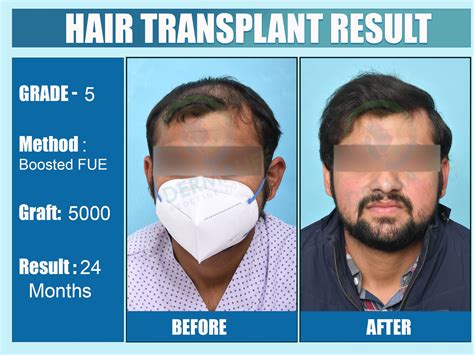 Before and After Results of Hair Transplant for Front