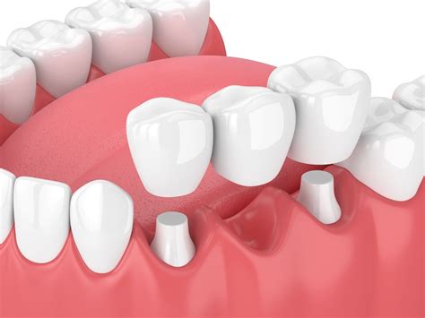 What Does a Dental Bridge Look Like? - McCartney Dental - North Port, FL