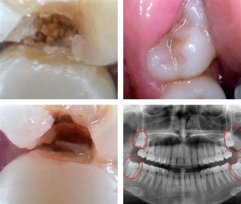 Wisdom Teeth Extraction 的图像结果