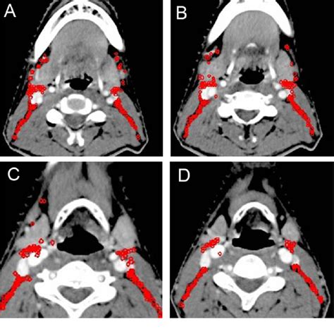 Shotty inguinal lymph nodes - polizdutch