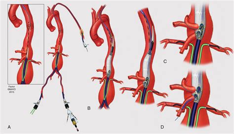 Fenestrated and Branched Endograft Treatment of Juxtarenal ...