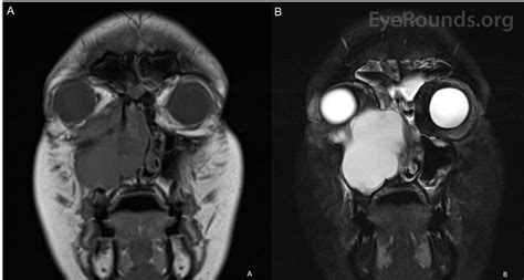 Retention Cyst Of The Maxillary Sinus Image
