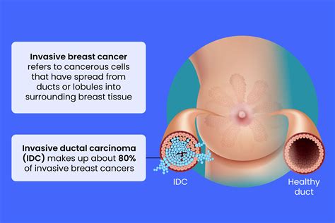 What Is Invasive Ductal Carcinoma - how common is breast cancer