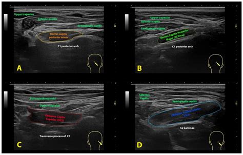 Obliquus Capitis Inferior