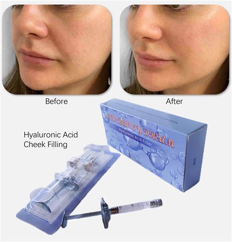Hyaluronic Acid Dermal Filler for Cheek Filling Derm 1ml - Hyaluronic Acid Dermal Filler and ...