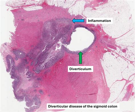 Your pathology report for diverticular disease | MyPathologyReport