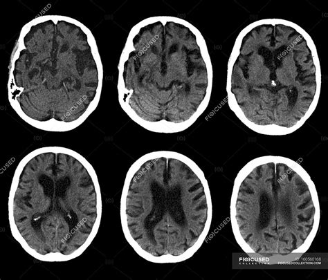 Normal human brain — organ, sextet - Stock Photo | #160560168