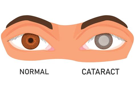 Self-Test For Cataracts