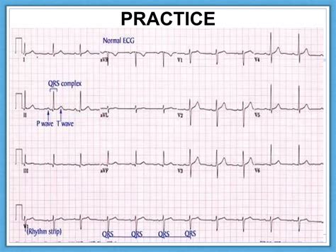 Normal ECG Read Out 的图像结果