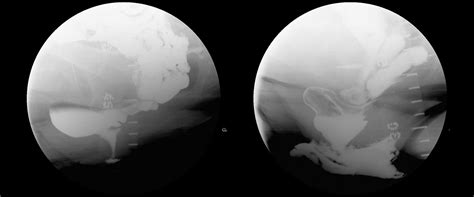 Image result for Obstructive Defaecation