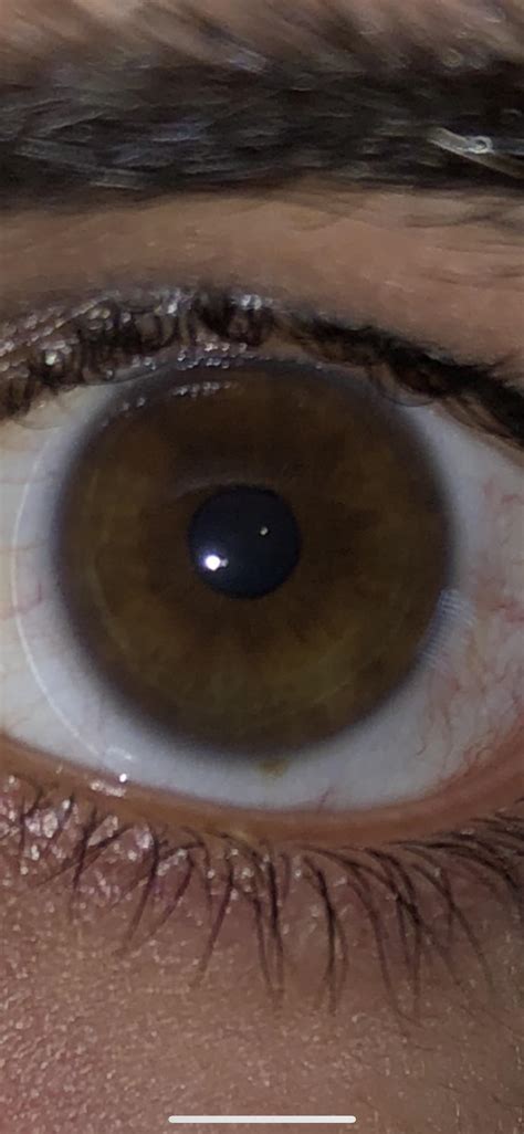 Brown Spot on eye. : r/eyetriage