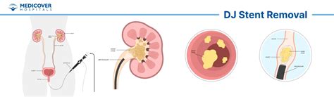 DJ Stent Removal Procedure: Procedure, Benefits & Risks