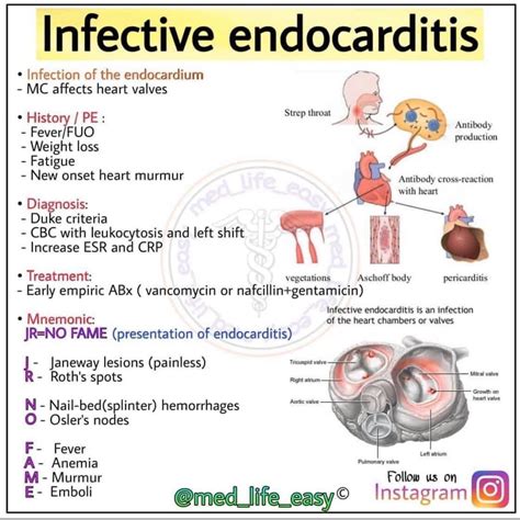 Infective endocarditis - MEDizzy