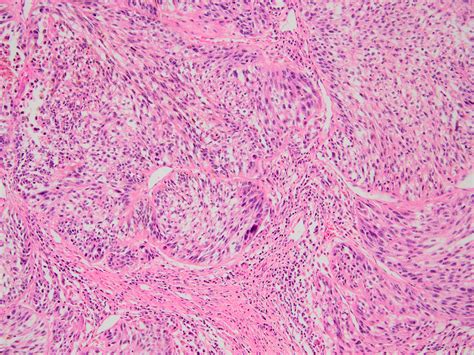 Spindle Cell Tumor Pathology Outlines at Sarah Bugarin blog