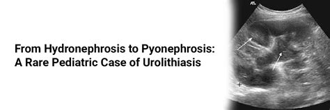 From Hydronephrosis to Pyonephrosis: A Rare Pediatric Case of Urolithiasis