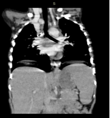 Multi system inflammatory syndrome in children (misc) - an incidental ...