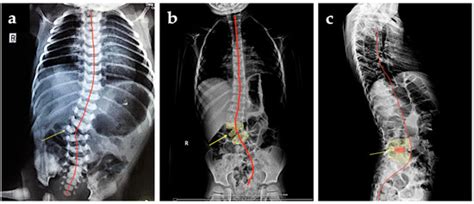 First-Trimester Diagnosis of Supernumerary Hemivertebra