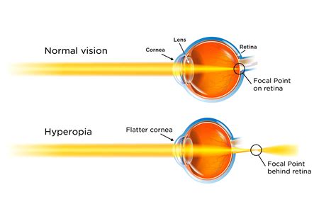 What Is Farsightedness