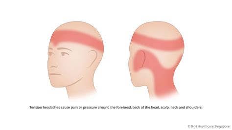 Tension Headache - Symptoms & Causes | Mount Elizabeth Hospitals
