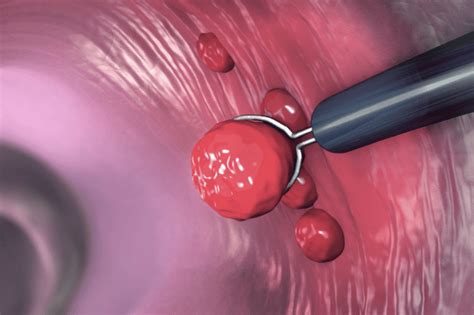 Image result for Polypectomy Recovery