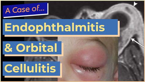 Endophthalmitis and Orbital Cellulitis - MedEd Cases